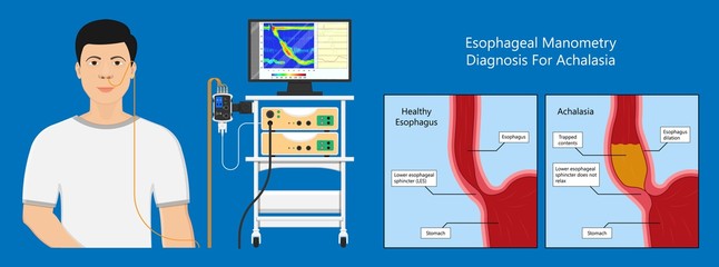 Esophageal manometry test esophageal diagnose food high resolution impedance HRM difficulty swallowing Achalasia treat acid - obrazy, fototapety, plakaty