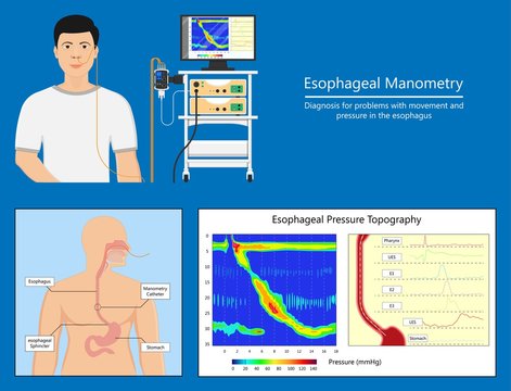 Esophageal Manometry Test Esophageal Diagnose Food High Resolution Impedance HRM Difficulty Swallowing Achalasia Treat Acid