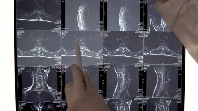 The doctor checks the results of MRI of the spine of the chest. The doctor examines the MRI image and shows the special places in the image with a pen.