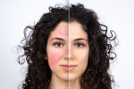 Collage comparing close up before and after successful rosacea treatment on face. Beautiful caucasian young lady portrait on white background. Medicine and healthcare concept.