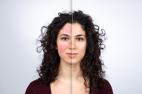 Collage comparing healthy skin and face suffering rosacea, visible blood vessels and capillaries. Caucasian curly haired woman portrait on white background. Medicine and healthcare concept.