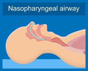 Suction patient adult nares unit lung clear fluid tube nose nasal pump treat nurse airway clinic device portable mucus oxygen emergency examination therapy sick anaesthetist pharynx pneumonia breathe