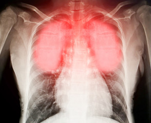 Virus destroys human lungs the lnflamed a radiograph