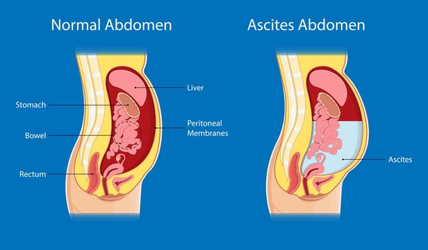 Ascites Paracentesis medical procedure diagnostic abdominal bacteria treatment therapy drainage