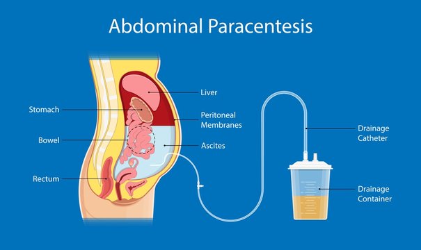 Ascites Paracentesis medical procedure diagnostic abdominal bacteria treatment therapy drainage