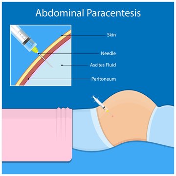 Ascites Paracentesis medical procedure diagnostic abdominal bacteria treatment therapy drainage