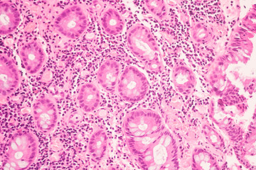 View in microscopic of ductal cell carcinoma, adenonocarcinoma from human breast cancer, tissue...