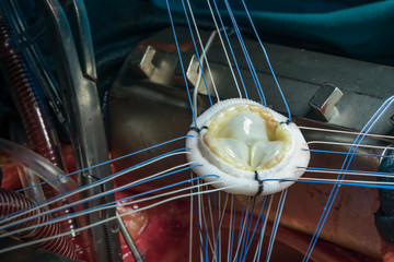 Heart valve prosthesis. Close up image of aortic valve implant during open heart surgery.