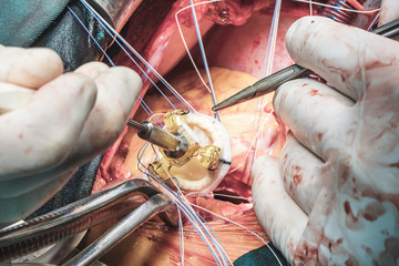 Heart valve inplantation
