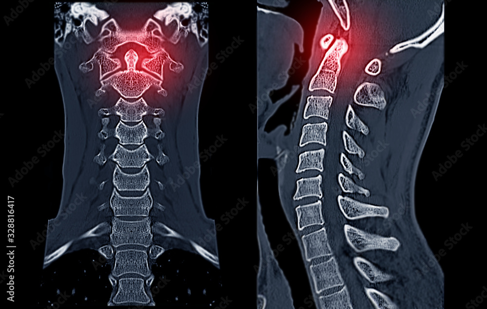 Poster compare of ct c-spine or cervical spine 3d rendering image and sagittal