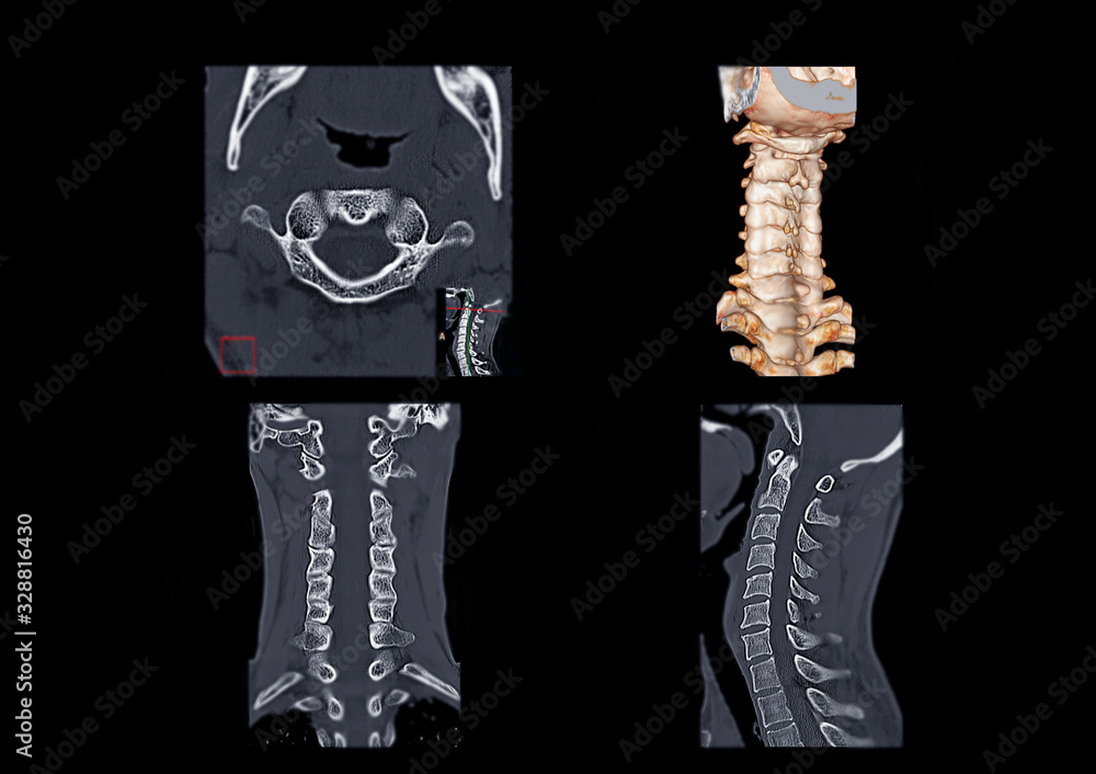 Poster ct c-spine or cervical spine axial view , 3d rendering image , corona and sagittal view i