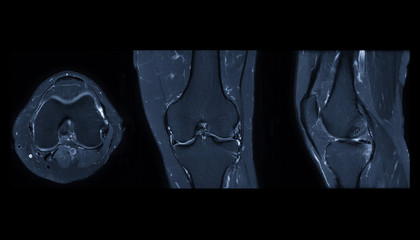 Compare of MRI knee or Magnetic resonance imaging of knee joint stir technique of axial, sagittal...