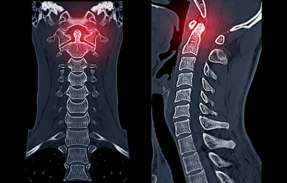 Compare of CT C-Spine or Cervical spine  3D Rendering image  and sagittal