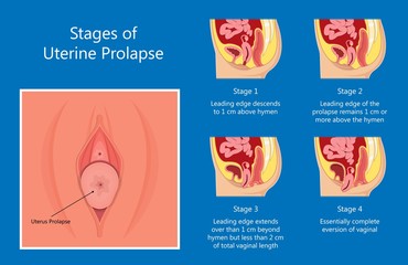 Pelvic floor prolapse type uterine uterus biofeedback pelvic floor treatment stage degree Kegel exercise surgery surgical therapy disorder cystocele urethrocele vaginal vault enterocele urethral exam