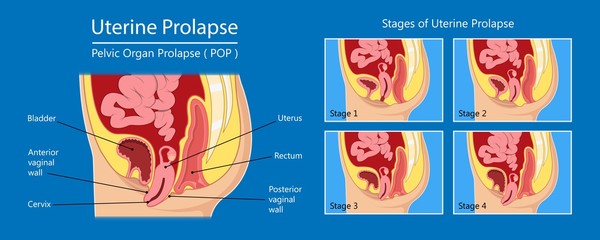 Pelvic floor prolapse type uterine uterus biofeedback pelvic floor treatment stage degree Kegel exercise surgery surgical therapy disorder cystocele urethrocele vaginal vault enterocele urethral exam