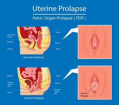 Stages of uterine prolapse. Pelvic floor muscles weakening, Support Stock  Vector