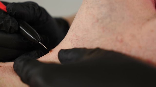 Electrocoagulation of papillomas. Cosmetician in black gloves removes papillomas on male neck in beauty clinic, dermatological cure. Doctor making laser removal of growths on skin, cosmetic one day