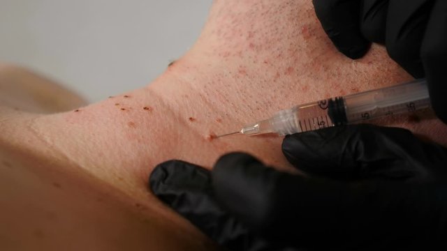 Male client in beauty clinic. surgeon in black gloves making pain-relieving injection before medical procedure. mole and Papillomas removing in medical centre. Doctor removes papilloma off male skin
