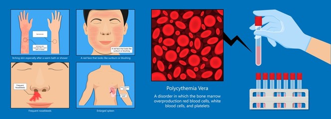 Polycythemia vera PV blood clots cancer bone marrow diagnostic complete count venous thromboses