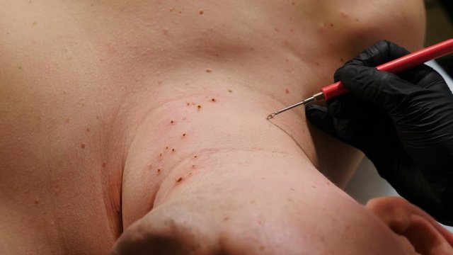 Electrocoagulation of papillomas. Surgeon removes papillomas on male neck with laser in beauty clinic, dermatological cure. Doctor making laser removal of growths on skin, cosmetic one day surgery. 4