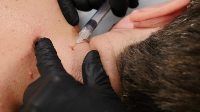 Male client in beauty clinic. surgeon in black gloves making pain-relieving injection before medical procedure. mole and Papillomas removing in medical centre. Doctor removes papilloma off male skin