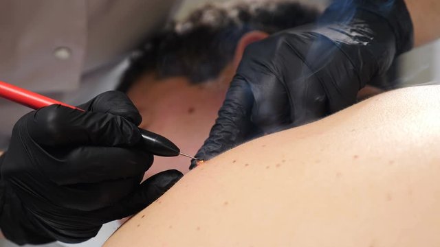 Electrocoagulation of papillomas. Cosmetician in black gloves removes papillomas on male neck in beauty clinic, dermatological cure. Doctor making laser removal of growths on skin, cosmetic one day
