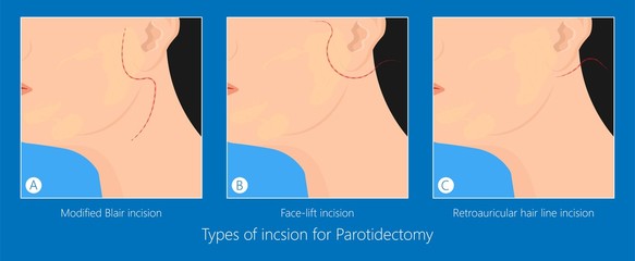 Parotid gland Sialadenitis bacterial infection Sialolithiasis blockage swelling treat Infiltrative cancer ear nose doctor calculi stones diagnose surgical examination inflammation saliva