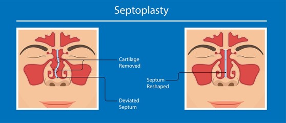 Septoplasty deviated nasal septum breath block blocked swell Nosebleed