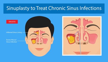 Sinusitis medical disease treat sinuses allergies surgical drug smart ENT endoscopy diagnose