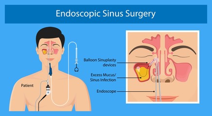 Sinusitis medical disease treat sinuses allergies surgical drug smart ENT endoscopy diagnose - obrazy, fototapety, plakaty