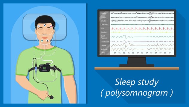 PSG Sleep Study Test Apnea Diagnose Periodic Limb Movement Disorder Positive Airway Pressure CPAP Restless Leg Syndrome Epworth Sleepiness Scale
