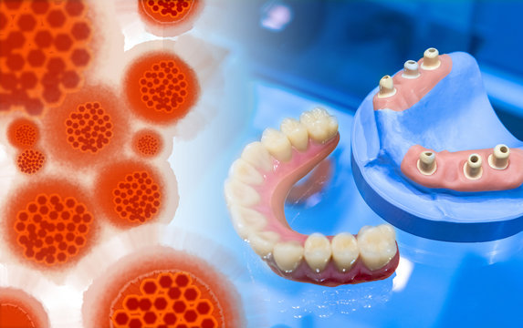Denture next to the image of infection. The symbol of the virus. Denture on the dentist's table. Concept - infection with dental implants. Concept - violation of sanitary standards by an orthodontist