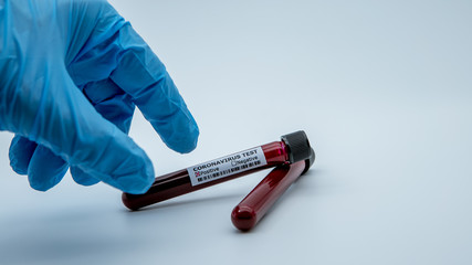 Obraz premium Positive COVID-19 test and laboratory sample blood testing for diagnosis