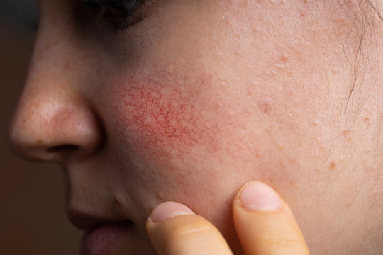 Closeup shot of rosacea redness on the cheek skin of a young woman