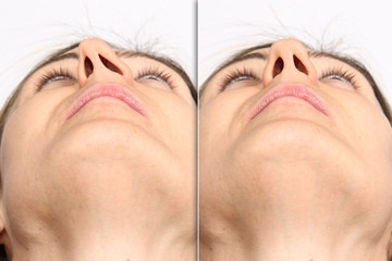 Deviated nasal septum before and after septoplasty surgery comparison - obrazy, fototapety, plakaty