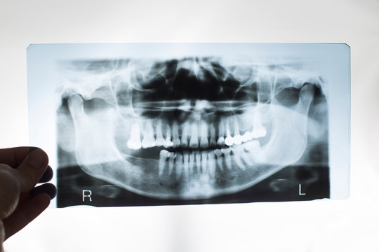 The dentist doctor holds in his hand an x-ray picture of the jaw with false teeth. Dental prosthetics concept with metal-ceramic crowns, periodontium