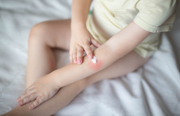Obraz na płótnie Canvas A small child smears redness on the hand with baby cream. The concept of treatment and skin care with a cream, rash and peeling in children, dermatology