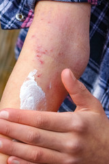 a wounds atepic dermatitis in the hands of a child