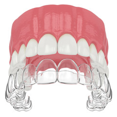 3d render of upper jaw with invisalign removable retainer © Aleksandra Gigowska