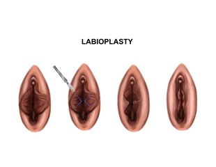 Illustration of the labioplasty. Before and after surgery - obrazy, fototapety, plakaty