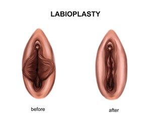 Illustration of the labioplasty. Before and after surgery - obrazy, fototapety, plakaty