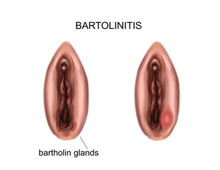Illustration of the inflammation of the bartholin glands. bartholinitis