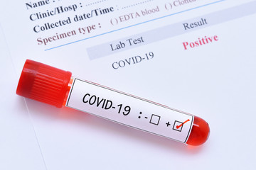 Blood sample tube positive with COVID-19 virus or novel coronavirus 2019 found in Wuhan, China