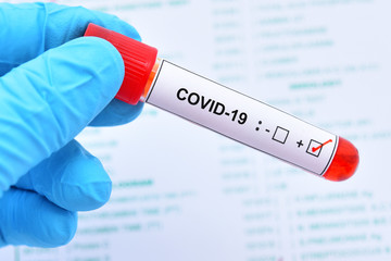 Blood sample tube positive with COVID-19 virus or novel coronavirus 2019 found in Wuhan, China