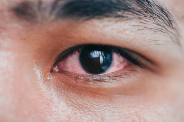 sick red eye conjunctivitis, tired eye, working at the computer