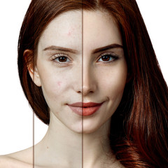 Redhead woman with acne before and after treatment.