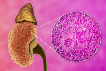 Chronic glomerulonephritis, 3D illustration showing pale contracted coarsely granular kidneys and light micrograph showing glomerulosclerosis, interstitial fibrosis and lymphocytic inflammation