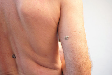 Back view of a Caucasian showing Seborrheic Keratosis at his right upper arm.  The white mole has...