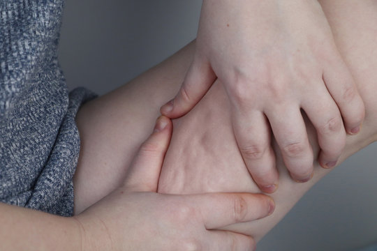 A doctor examines a patient&rsquo;s leg with lipodystrophy. A magnifying glass shows cellulite. The concept of obesity and treatment of liposclerosis (orange peel)