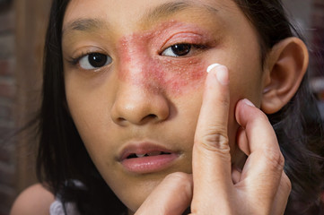 Southeast Asian ethnicity teenage girl with circular shape  skin rash on her face around the eye and nose, being applied Antifungal cream for medication. Tinea corporis dermatitis skin problem
